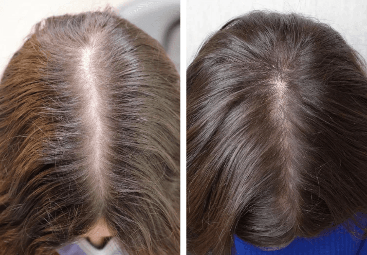 Kirkland Minoxidil 5% Homme 60 Jours + Derma Roller
