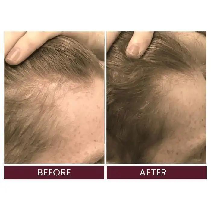 Kirkland Minoxidil 5% Homme Traitement Repousse Cheveux 2 Mois