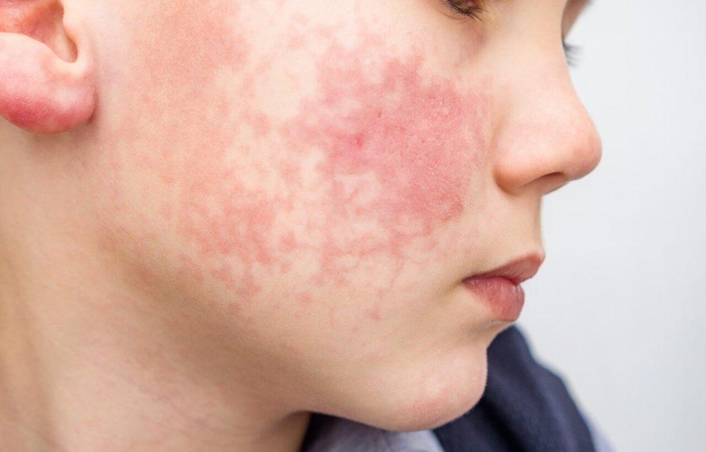 Anua Pack Azelic acide Purito crème hydratante à base de panthénol
