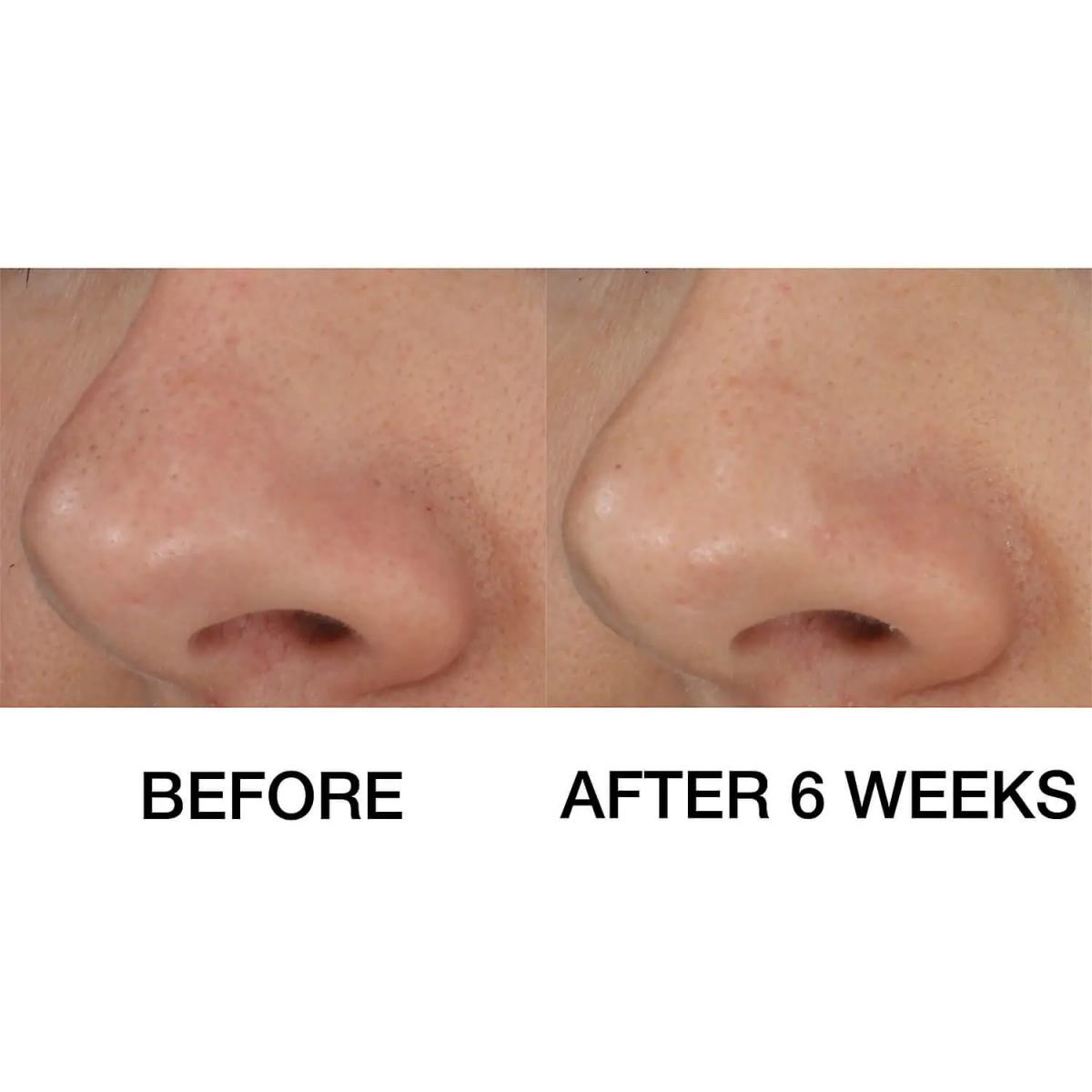 Clinique BLACKHEAD SOLUTIONS 20ML