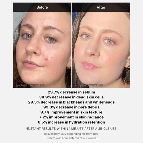 Medicube Red Acne Succinic Acid Peel Sérum peeling 40g